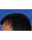 After Hair Transplant&nbsp;2 Sessions (Areas)